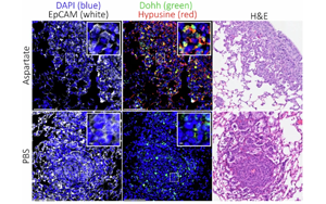 Nature：癌癥轉(zhuǎn)移時為何青睞肺部？