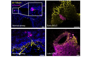 癌細(xì)胞會(huì)放電？Nature揭示小細(xì)胞肺癌擴(kuò)散新機(jī)制