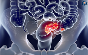 Nature｜華大攜手瑞典烏普薩拉大學發(fā)表全球最大規(guī)模結直腸癌多組學研究