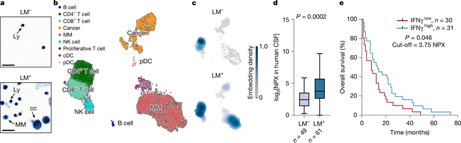  炎癥誘導(dǎo)的腦脊液細(xì)胞增多見于軟腦膜轉(zhuǎn)移患者