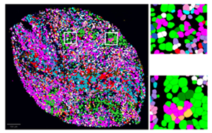腫瘤微環(huán)境分析發(fā)現(xiàn)肺癌的治療應(yīng)答標(biāo)志物