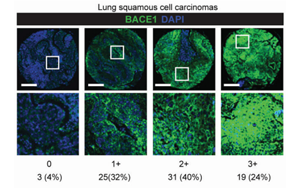 CRISPR激活篩選揭示BACE1驅(qū)動(dòng)非小細(xì)胞肺癌腦轉(zhuǎn)移的機(jī)制及治療潛力
