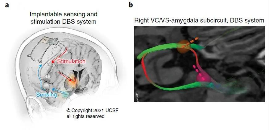腦電刺激成功拯救重度抑郁癥患者，治愈抑郁癥時代離我們不遠(yuǎn)了？