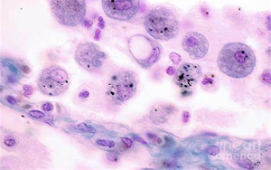 Science Immunology：巨噬細(xì)胞發(fā)育缺陷導(dǎo)致肺部疾病